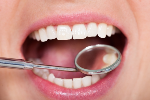 Dental Fillings: What to Expect, Types, and Potential Issues from Smile Solutions in Pittsburg, KS