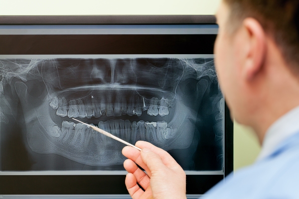 3 Reasons You May Need a Dental Filling from Smile Solutions in Pittsburg, KS