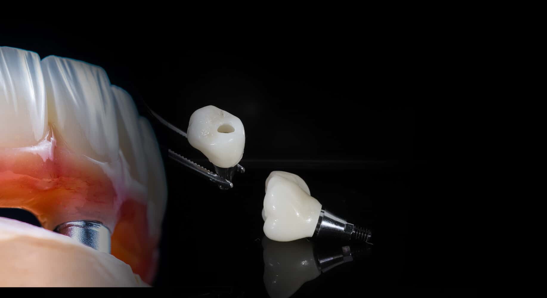 Dental Implants